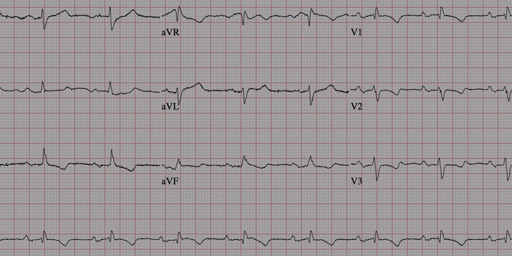 ECG or PPG ? What are they and which is better ? Heart rate tracking
