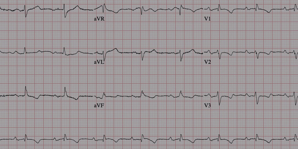 ECG or PPG ? What are they and which is better ? Heart rate tracking