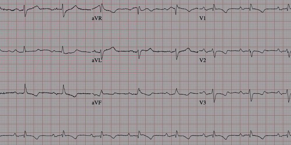 ECG or PPG ? What are they and which is better ? Heart rate tracking